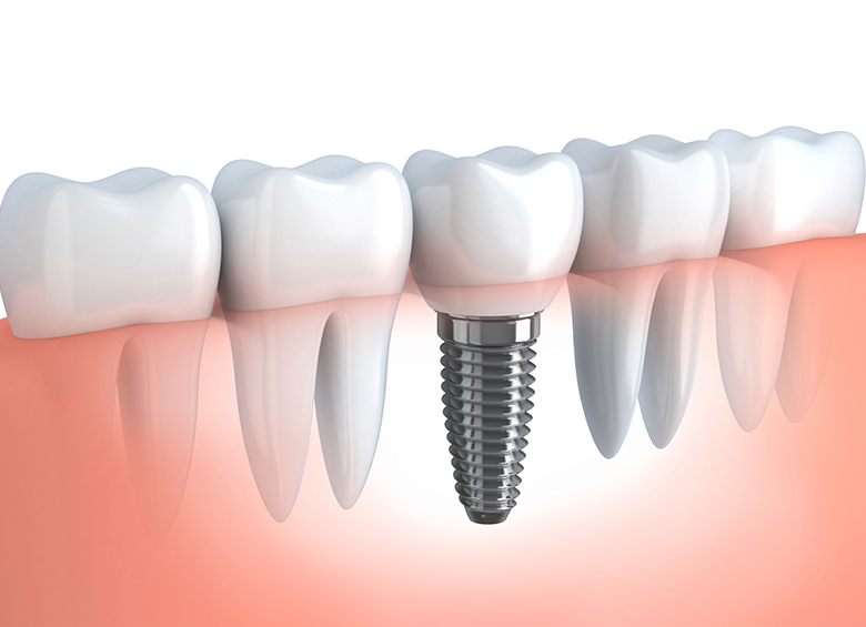 implantes